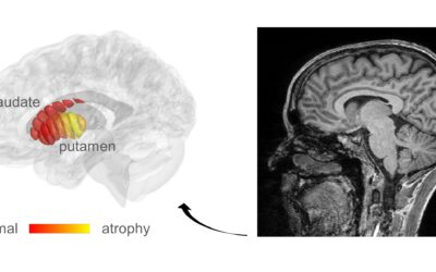 Escáner cerebral para detección temprana del Párkinson inventado en Israel